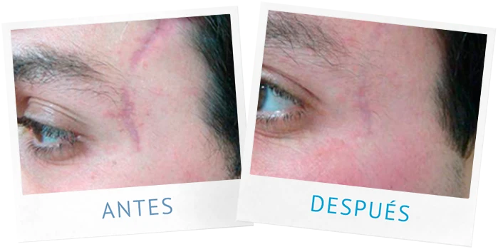Resultados: Cicatrices y acné