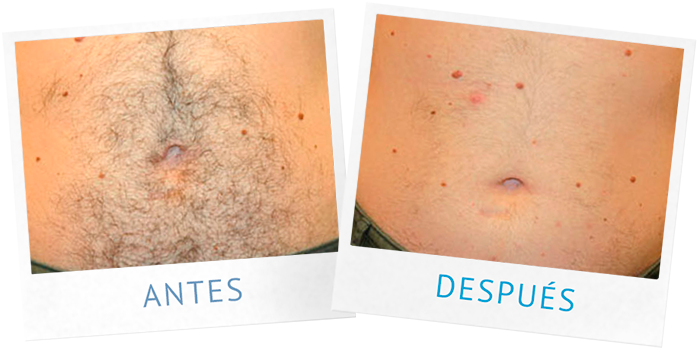 Resultados: Después de 6 meses y 2 sesiones