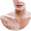 Enfermedades autoinmunes de la piel: Vitiligo