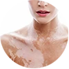 Enfermedades autoinmunes de la piel: Vitiligo